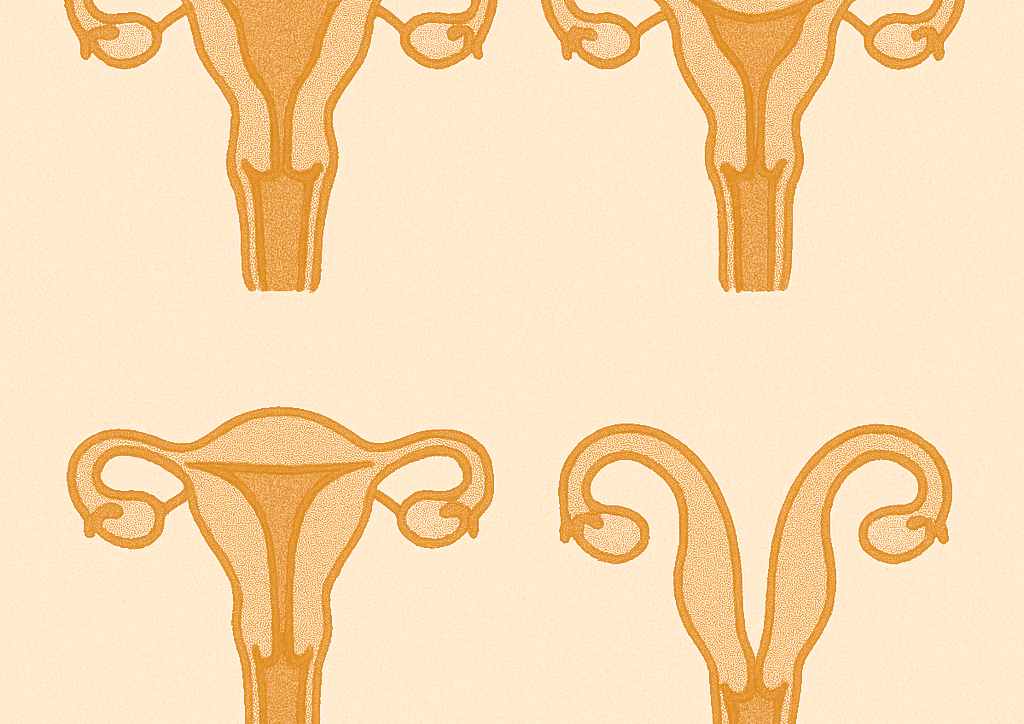 aangeboren baarmoederafwijkingen - Verloskundige Kampen PuurBegni