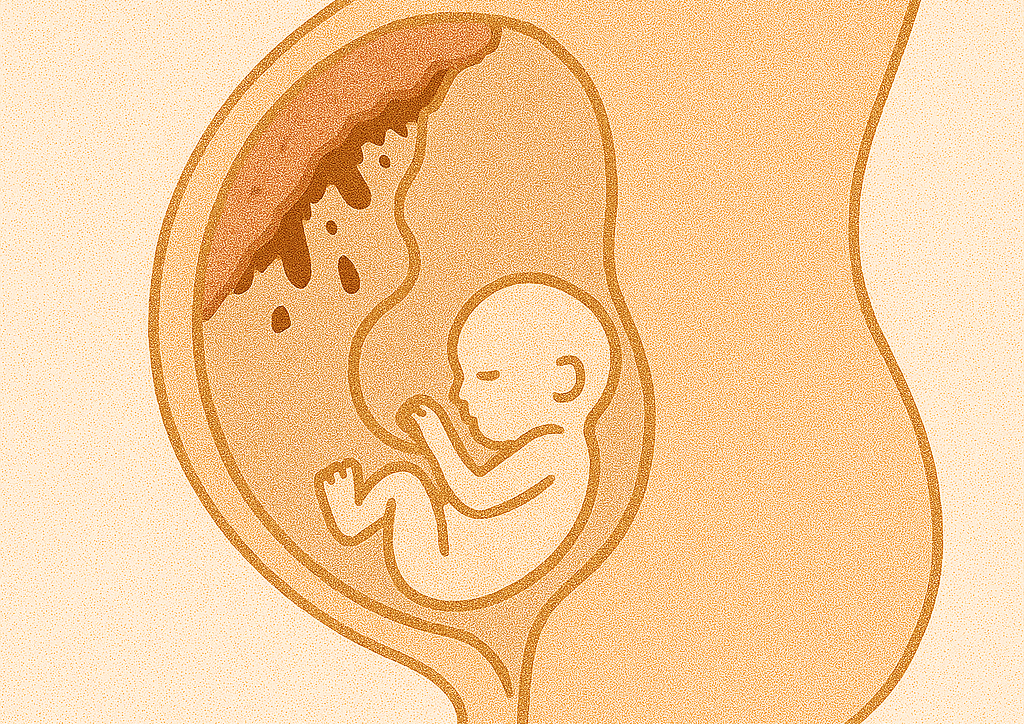 placentaire abruptie - Verloskundige Kampen PuurBegin