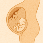 placentaire abruptie - Verloskundige Kampen PuurBegin